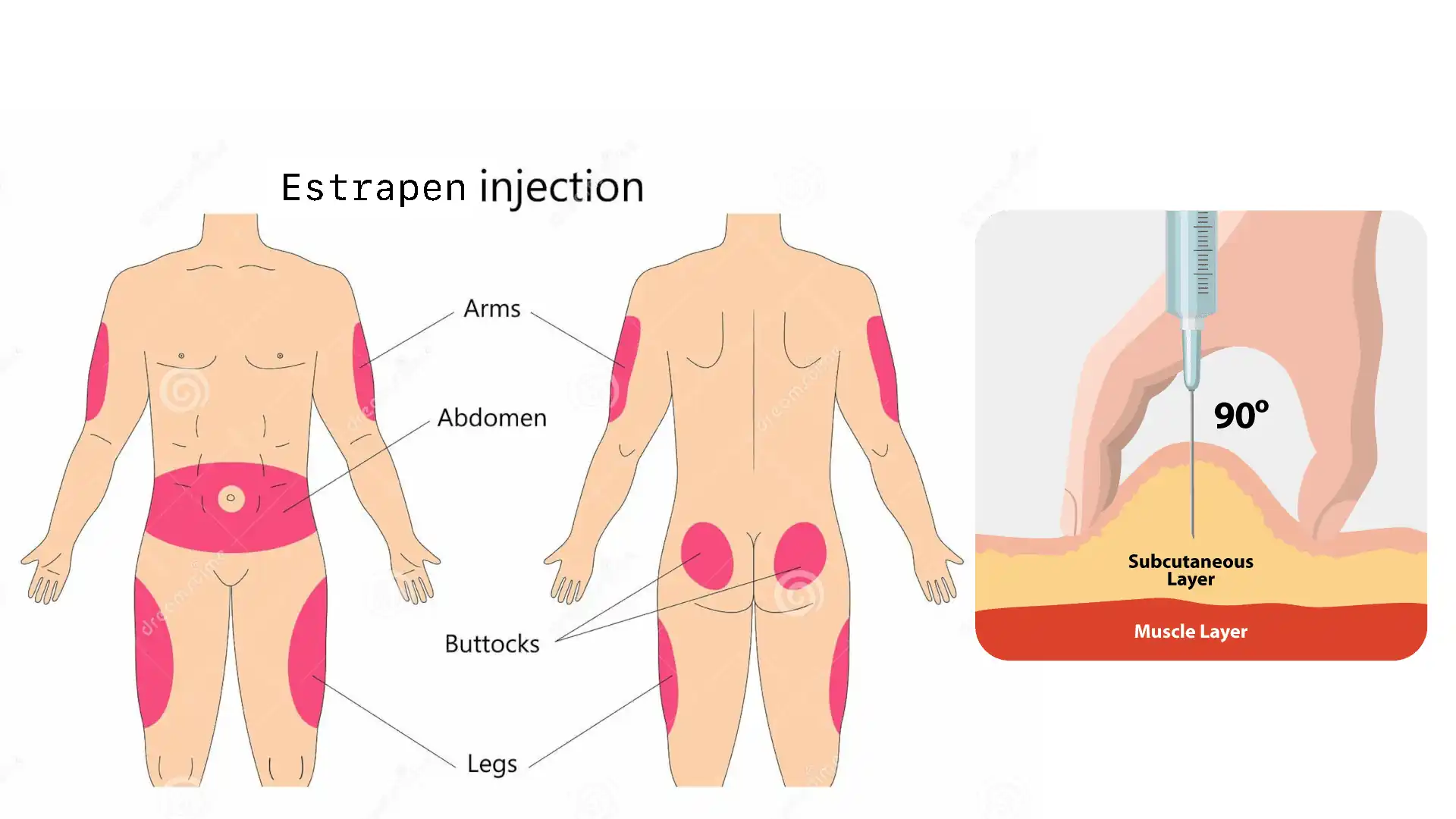 Graphic highlighting glutes, the abdomen, outer upper thighs, and the back of arms.